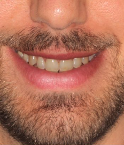 Antes