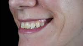 Antes